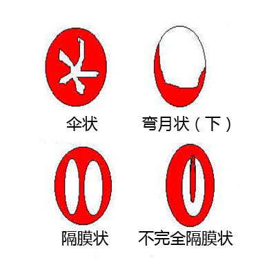 圖解處女膜:在哪兒,長啥樣?