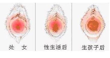 科普圖解:處女膜在陰道什麼位置