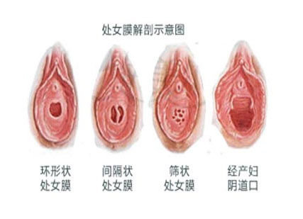 科普圖解:處女膜在陰道什麼位置